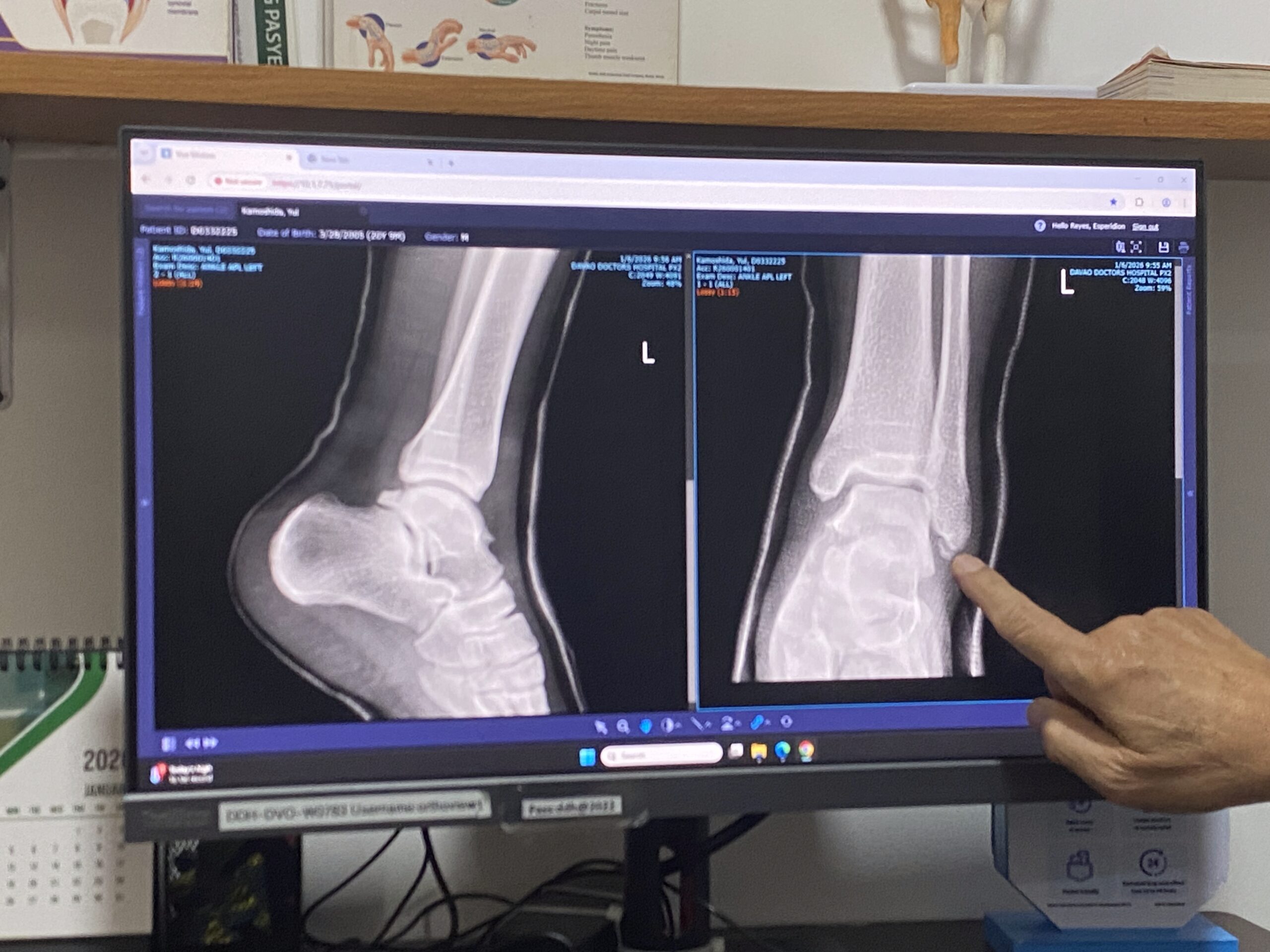 レントゲン　DDH