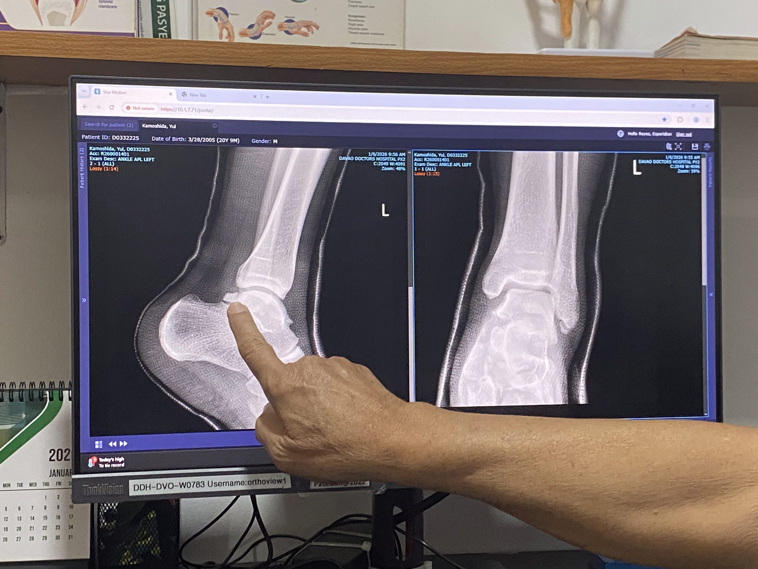 レントゲン　DDH